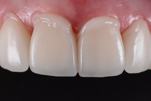 Adhesiones en Ontario, CA | Adhesiones Dentales | Esparza Dentistry
