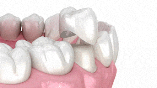 Dental Crowns Cosmetic Dentist in Ontario CA Esparza Dentistry