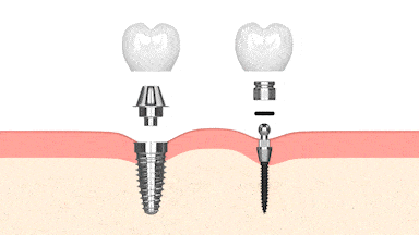 Implantes Dentales en Ontario, CA