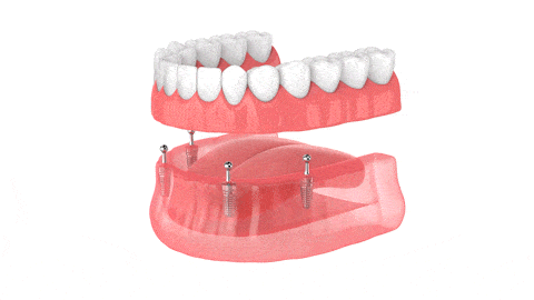 Dentaduras en Ontario, CA Esparza Dentistry