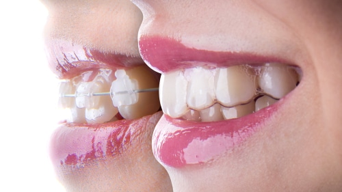Ortodoncia con frenos rápidos vs. Ortodoncia con frenos tradicionales en Ontario, CA