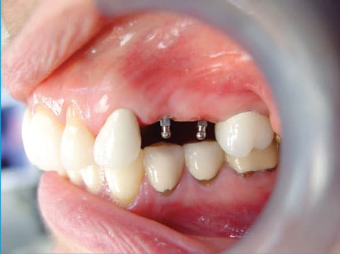 Mini Dental Implants in Ontario, CA Esparza Dentistry