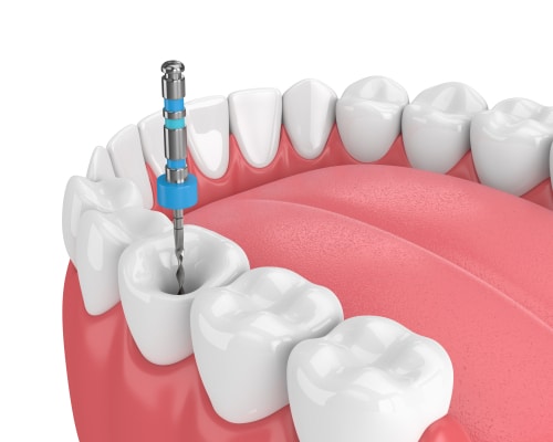 Endodoncia en Ontario CA Esparza Dentistry