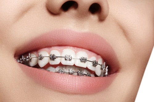 Fast Braces vs. Traditional Braces: Align Your Smile Fast