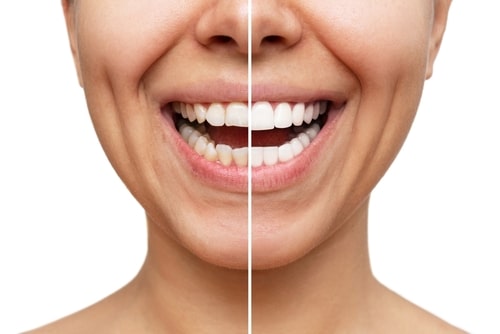 Carillas Dentales: Resalte su mejor sonrisa | Ontario, CA