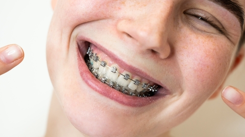 Braces in Ontario, CA | Orthodontic Treatment | Free Consultations
