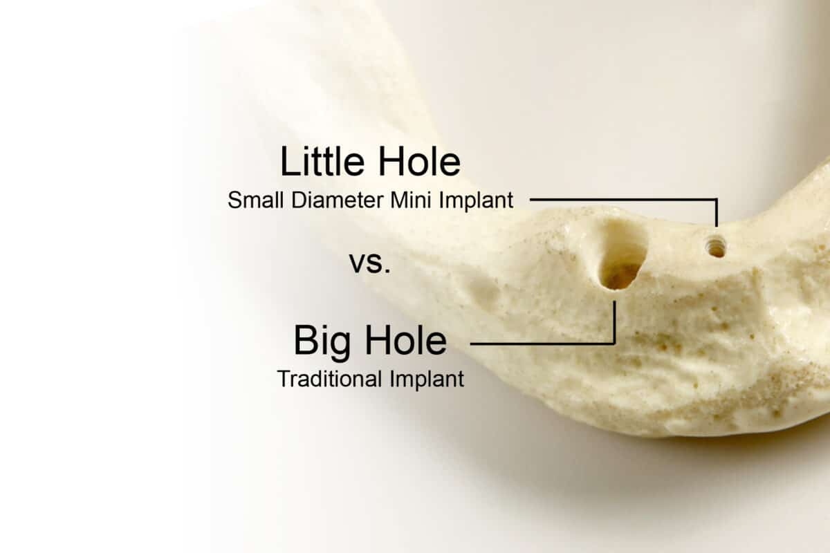 Mini Implants vs. Traditional Implants in Ontario, CA