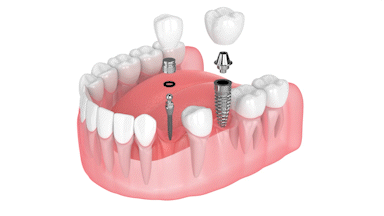 Implantes Dentales en Ontario, CA | Mini Implantes | Consultas Gratuitas