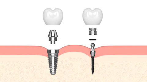 ClearChoice Alternatives in Ontario, CA | Mini Implants | New Teeth