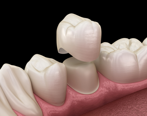 Coronas CEREC en Ontario, CA | Mini Implantes Dentales | Dientes Nuevos