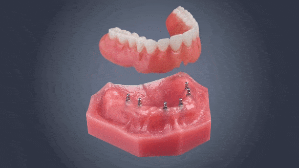 Reemplazo de Dentadura en Ontario, CA | Mini Implante | Puente de Implantes