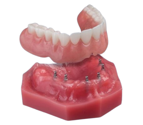 Snap-in Dentures in Ontario, CA | Mini Implants | Free Consultation