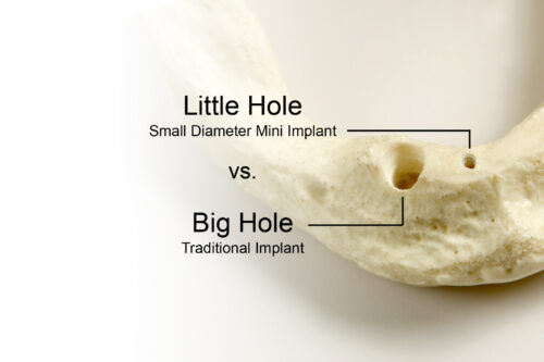 Dental Implants in Ontario, CA Mini Dental Implant Centers of AMerica Esparza Dentistry