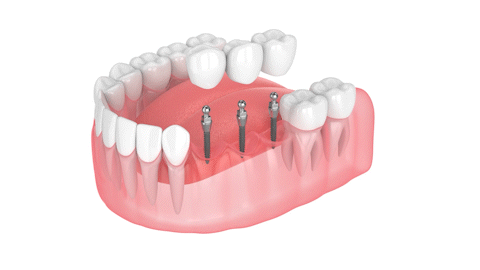 Implant Bridges in Ontario, CA Mini Dental Implant Centers of AMerica Esparza Dentistry