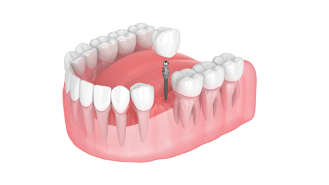 Implant Dentist in Ontario, CA Mini Dental Implant Centers of AMerica Esparza Dentistry
