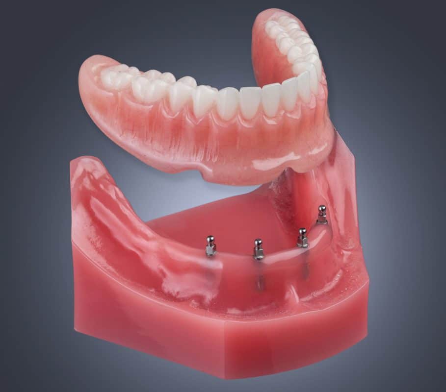 Dentaduras Flotantes | Mini Implantes en Ontario, CA | Consulta Gratuita