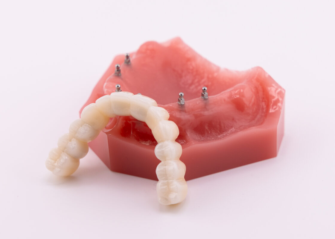 Mini Implant Dentures Cost | Affordable Dentures in Ontario, CA