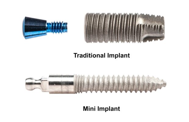 Traditional Dental Implants | Mini Implants in Ontario, CA