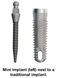 Mini Dental Implants vs. Traditional Implants in Ontario, CA