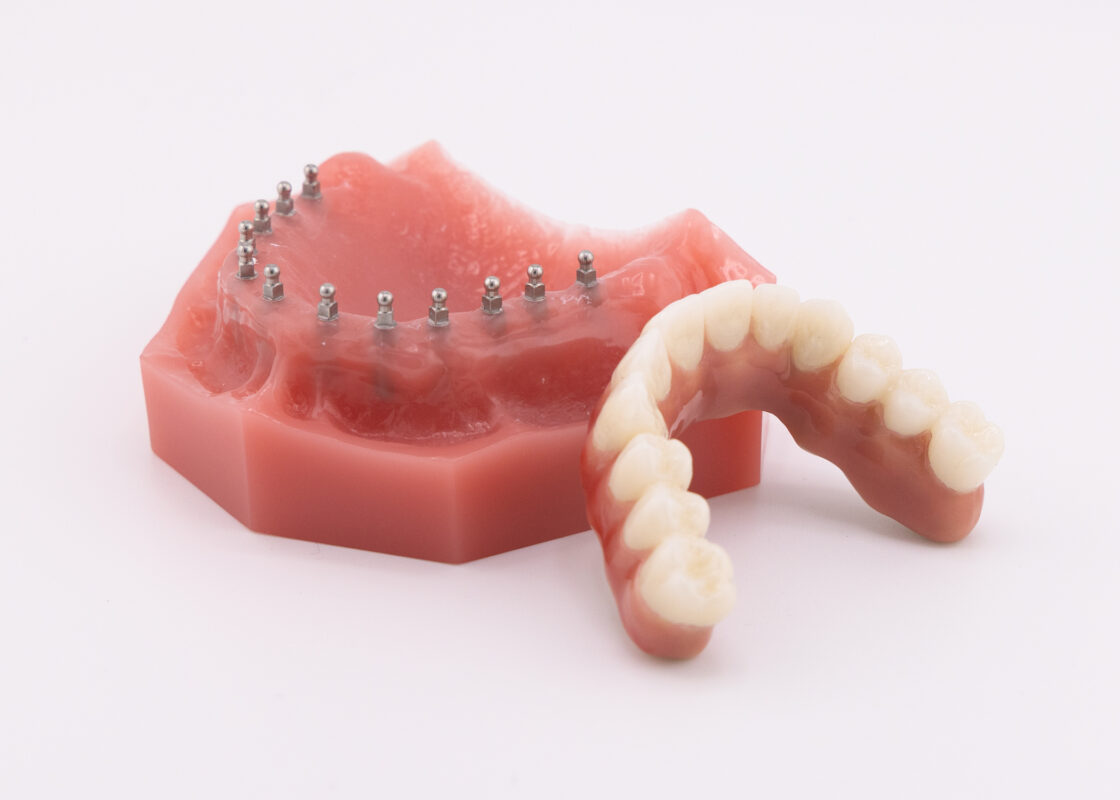 Full Arch Dental Implants in Ontario, CA | Book a Free Consultation!