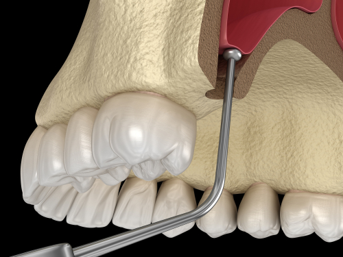 Sinus Lift in Ontario, CA | Book a FREE Consultation Today!