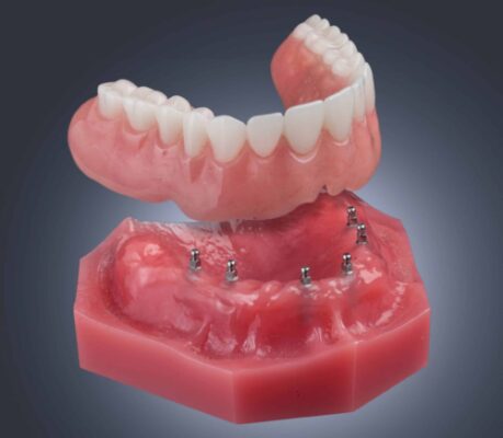 What Are Snap On Dentures | Affordable Implants in Ontario, CA