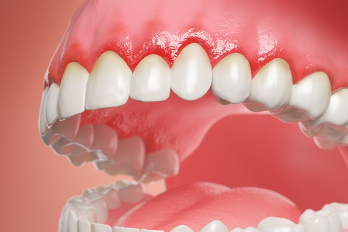 Does Periodontitis Go Away? | Gum Disease Treatment in Ontario