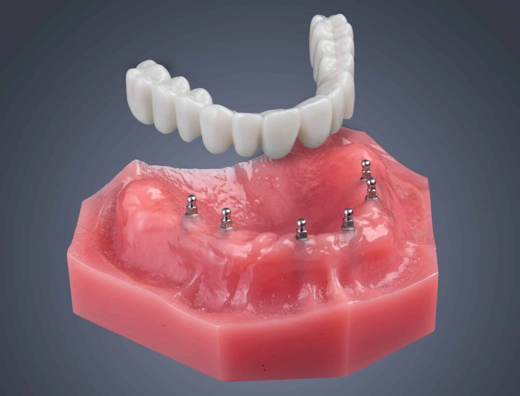 Implantes dentales para toda la boca en Ontario, California | Consultas gratuitas