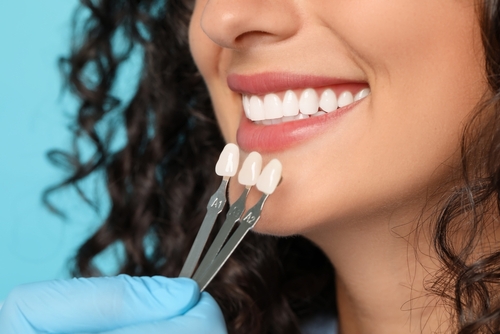 What Are Porcelain Veneers? | Cosmetic Dentist in Ontario, CA