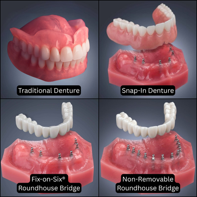 ¿Qué son las dentaduras sobre implantes? | Implantes dentales a precios accesibles en Ontario