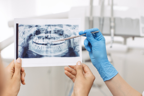 Implantes dentales mínimamente invasivos en Ontario | Opciones de financiamiento disponibles