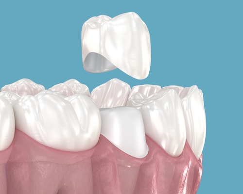 CEREC Crowns in Ontario, CA | Affordable Dentistry Near Me