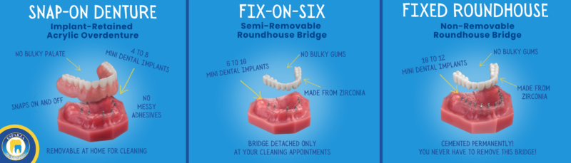 Denture Replacement in Ontario, CA | Mini Implant Denture Options