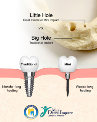 Small-Diameter Dental Implants in Ontario, CA | Mini Implants vs Traditional Implants